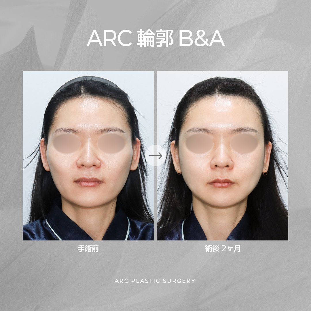 ARC_ps_'s tweet photo. 🚨🏆輪郭手術を考えている方へ、今年最大級のEVENT開催‼️🏆🚨

＼＼ARCクォン���表院長 輪郭EVENT／／

🔥🔥輪郭3点パッケージ『899万ウォン』🔥🔥

ただ小さくするだけじゃない‼️‼️
✨頬骨縮小
✨エラ形成
✨顎先形成
➕
💎皮質骨切除
💎咬筋縮小
💎バッカルファット除去

ここまで含めた
『輪郭フルパッケージ』をご用意しました👨‍⚕️✨
しかも📢
CT診断後に、本当に必要な施術だけをクォン代表院長と相談可能💡

『全部やる』ではなく、
あなたの骨格に合わせて最適な組み合わせをご提案します😊

🎉EVENT詳細🎉

🎯今年中に手術を受けられる方
『20名様限定』

🎯部分モニター条件適用

🎯詳しい内容はLINEでお問い合わせ📩

⚠️モニター枠には限りがあります。
定員に達し次第終了となります🙇‍♂️

輪郭専門だからできる、
骨格全体を考えたオーダーメイド輪郭デザイン🦴✨

こ��機会をお見逃しなく💙LINE💌https://t.co/S0uJiuoIUh

#ARC美容整形外科 #輪郭3点 #輪郭手術 #クォン代表院長 #韓国整形 #頬骨縮小 #エラ形成 #顎形成 #皮質骨切除 #咬筋縮小 #バッカルファット除去 #輪郭イベント #韓国輪郭 🦴✨🎉💙🇰🇷🔥