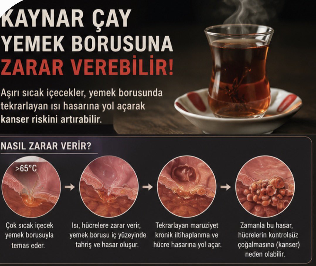 drdaisyy's tweet photo. Çay milli içeceğimiz, pek severiz, faydası da bol
Ama
Aşırı sıcak içiyoruz🔥
Kaynar olmadan içemiyorum diyorsanız:
🚨Çay, ağzınızı yakıyorsa yemek borunuz için de bu sıcaklık fazla demek
📌65°C’nin üzerindeki içecekler, yemek borusunda tekrarlayan ısı hasarına yol açabildiği için yemek borusu kanseri riskini artırabildiği gösterilmiş (özellikle günde 700ccden fazla böyle içenlerde risk artışı belirgin)
✅☕️ Çayınızı biraz bekletin, ılımasını bekleyin; keyfinden değil, sadece yakıcılığından vazgeçin

#adımadımiyiye