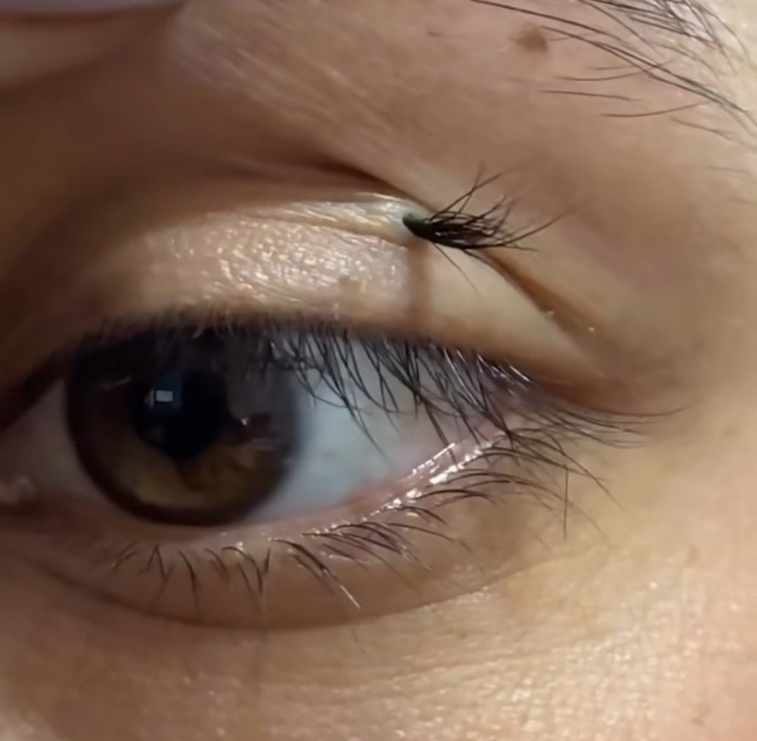 Laineytales's tweet photo. This suddenly appeared on my younger brother's eyelid; we have no idea what it is, and he is really scared. Does anyone know what this might be? https://t.co/T2dngqTQCv