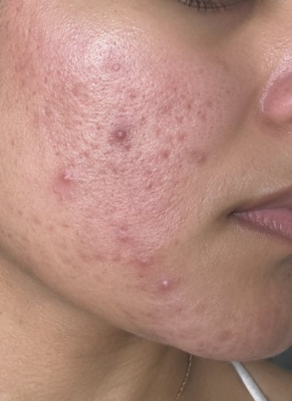 dr_sheena_derm's tweet photo. Had an online consult @dermatnow in January. 

What had started as 1-2 acne a year ago went on to involve almost entire face with constant redness and irritation.

She tried everything - retinoids, antibiotics, isotretinoin

But everything worsened it.

The answer was from a year ago