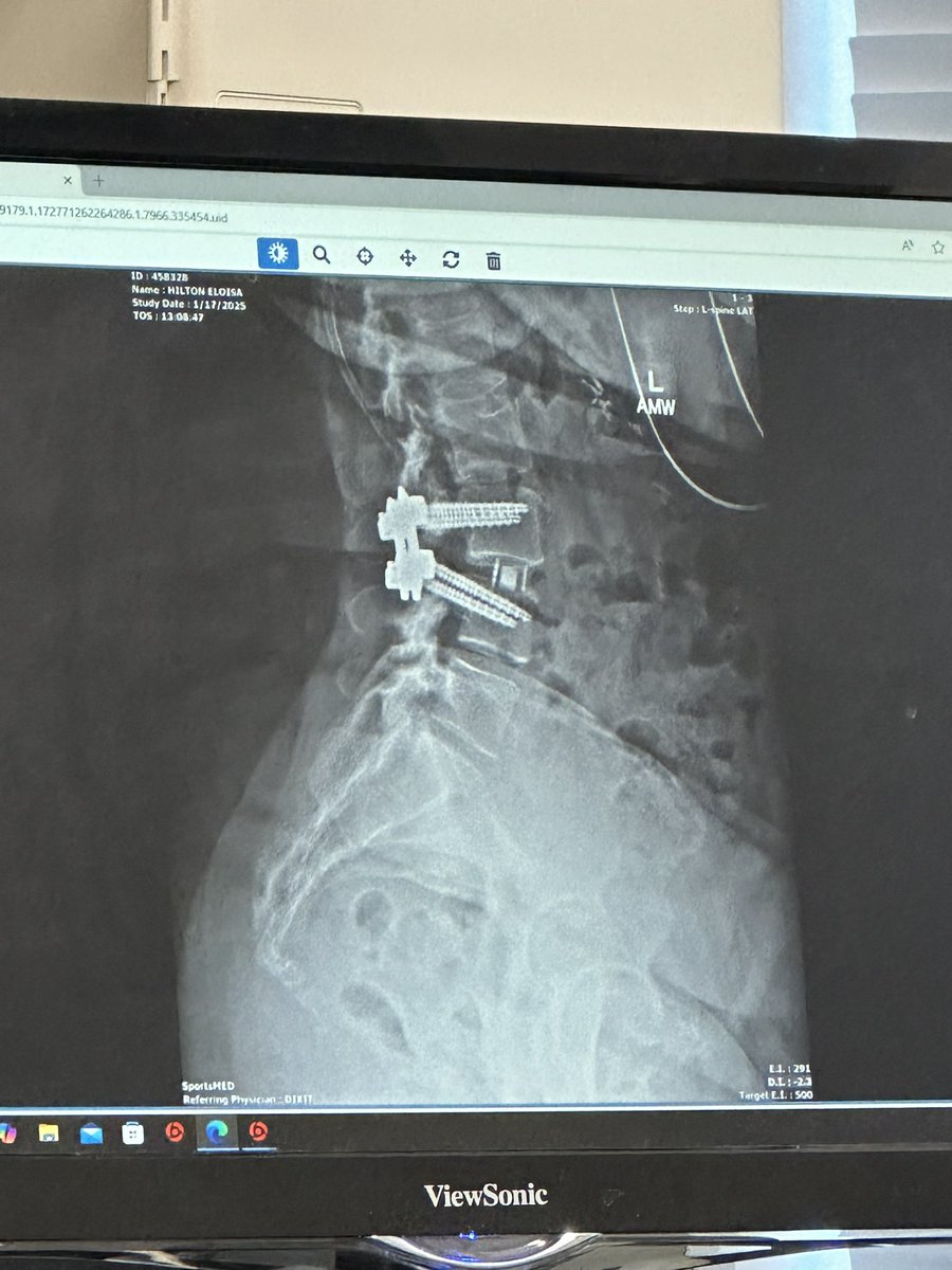 eloisaconde77's tweet photo. In 2024, I had a spinal fusion and decompression. It legit gave me my life back. However, when there is a weather system coming through, I hurt. Today I hurt a lot. Send memes, jokes, puppies-
#spinalfusion #backsurgery #recovery https://t.co/mgVzqdTNMg