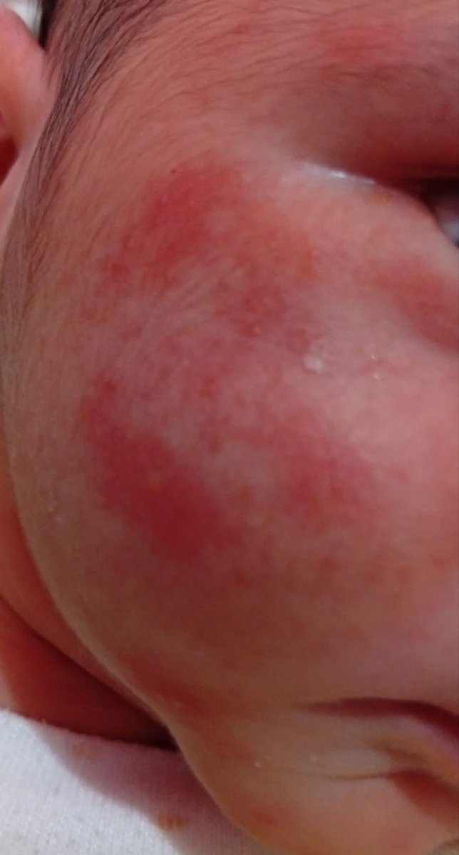 Dr_SaebGaza's tweet photo. The picture clearly doesn't do justice to how red my child's face is. He is in poor condition and has a high fever. 😭🙏🏻

 Donate $100 https://t.co/rgNSOCFzPz