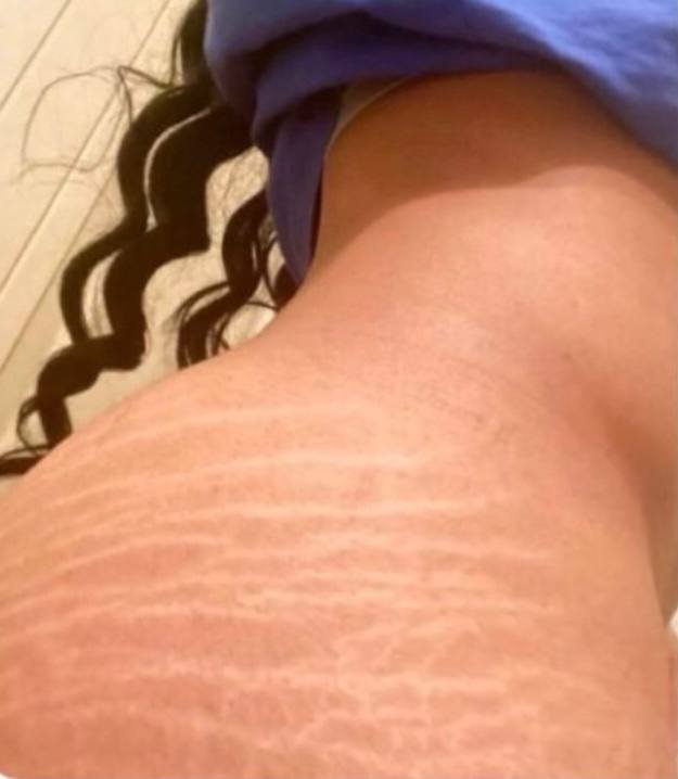 itspixora's tweet photo. Hey @grok can you explain what causes stretch marks like these to appear? https://t.co/Jhw5fC1Id7