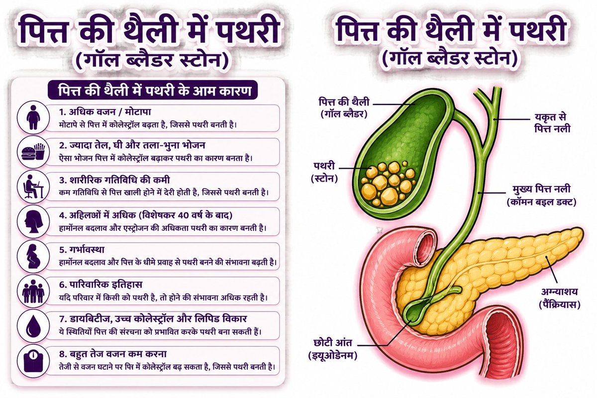 woww_great's tweet photo. पित्त की पथरी (Gallstones) होने के आम कारण

पित्त की पथरी यानी गॉलस्टोन एक ऐसी समस्या है जो आजकल बहुत लोगों में देखी जा रही है। यह छोटी-छोटी सख्त गांठें होती हैं जो पित्ताशय (Gallbladder) में बन जाती हैं। https://t.co/2tbyY1wAD6 https://t.co/4ND4Gevobz