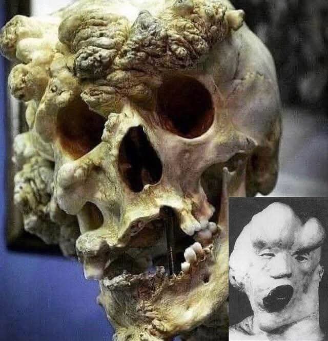 histories_arch's tweet photo. The skull of Joseph Merrick aka The Elephant Man... 

Merrick was born in Leicester, England, in 1862. His early childhood appeared normal, but by the age of five, unusual growths began to appear on his skin and bones. As he grew older, large bony masses developed on his skull, jaw, and limbs, causing his head to enlarge dramatically. His skull circumference eventually measured over 36 inches (about 91 centimeters).

His right arm and hand became severely deformed and mostly useless, while his left arm remained normal. Massive skin overgrowths and thickened folds hung from parts of his face and body, adding to his unusual appearance. 

These deformities made him a subject of medical fascination and, sadly, exploitation. Merrick spent years exhibited as a sideshow curiosity across Britain and Europe.

Modern researchers believe his condition was most likely Proteus syndrome—a rare genetic disorder that causes overgrowth of bones, skin, and other tissues though neurofibromatosis type I may also have contributed.

Merrick eventually found refuge at the Royal London Hospital under the care of Dr. Frederick Treves. He spent his final years there, treated with dignity and compassion, until he 1890 when he passed away at the age of 27.

#archaeohistories