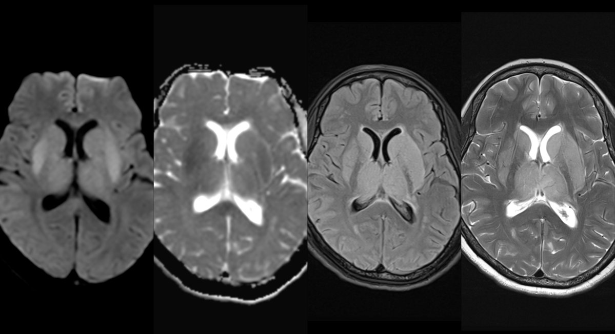 Dr. Nikhil R M (NeuroRad) tweet media