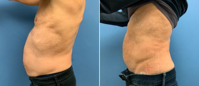 CosmetiCare's tweet photo. Before and after of Liposuction ✨

Schedule your consultation with one of our Board-Certified plastic surgeons today by calling 949-446-1542! https://t.co/uDMr767htz