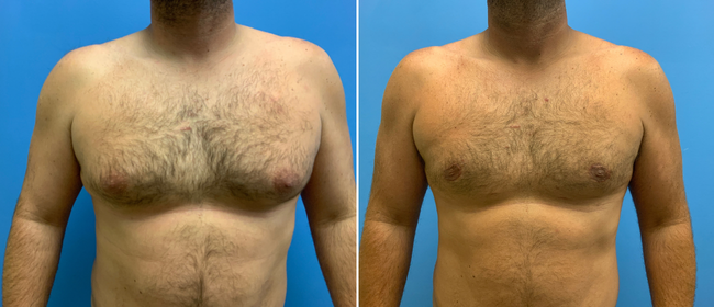 CosmetiCare's tweet photo. Before and after of a Gynecomastia ✨

Schedule your consultation with one of our Board-Certified plastic surgeons today by calling 949-446-1542! https://t.co/ogpw4knGu9