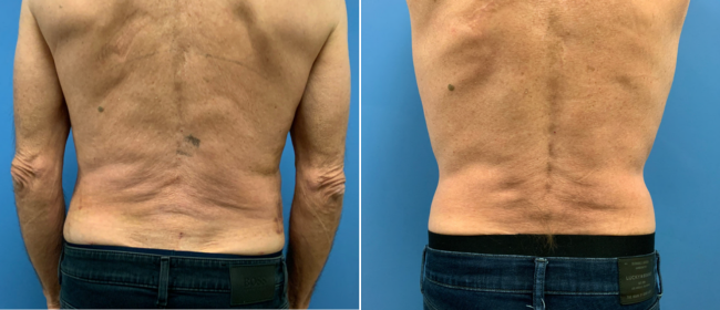 CosmetiCare's tweet photo. Before and after of Liposuction ✨

Schedule your consultation with one of our Board-Certified plastic surgeons today by calling 949-446-1542! https://t.co/pI5JKnZ9QY