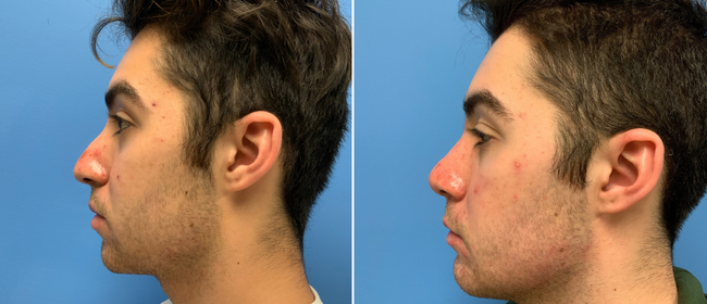 CosmetiCare's tweet photo. Before and after of a Rhinoplasty! ✨

Schedule your consultation with one of our Board-Certified plastic surgeons today by calling 949-446-1542! https://t.co/bwJ5woKkHu