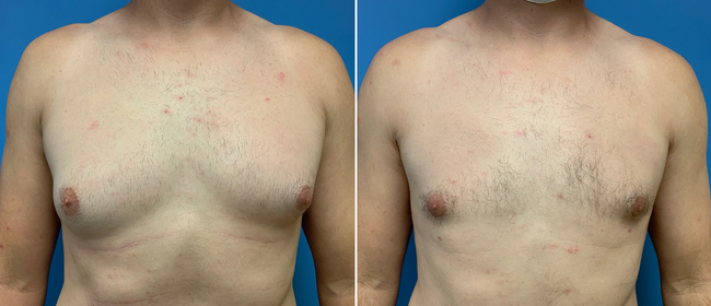CosmetiCare's tweet photo. Before and after of a Gynecomastia ✨

Schedule your consultation with one of our Board-Certified plastic surgeons today by calling 949-446-1542! https://t.co/ta6yFETFI7