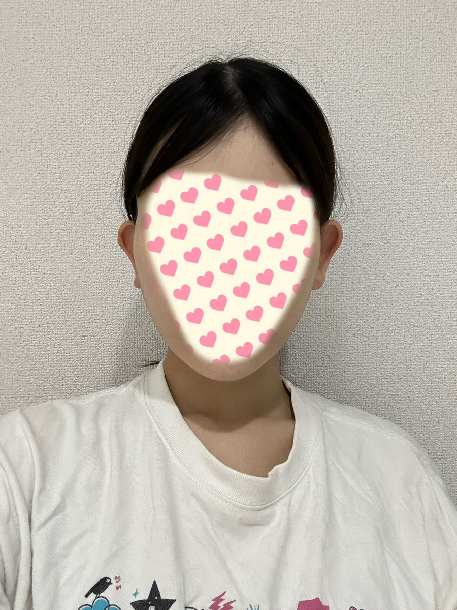 J8bOzy's tweet photo. @planetps_ko さんで切開リフトをして10日経ちました！
鏡で見た感じ変化が一目瞭然で嬉しいです。
抜糸も終わり、まだまだ腫れと拘縮が引くのが楽しみです。 https://t.co/wELpcRZrns