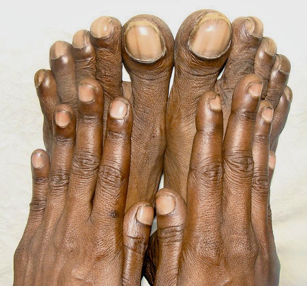 TrackYourHeart's tweet photo. This patient has marked clubbing of the toes, while the fingers are relatively less affected.

What diagnosis does this pattern strongly suggest? https://t.co/LuLR5fkiZ5