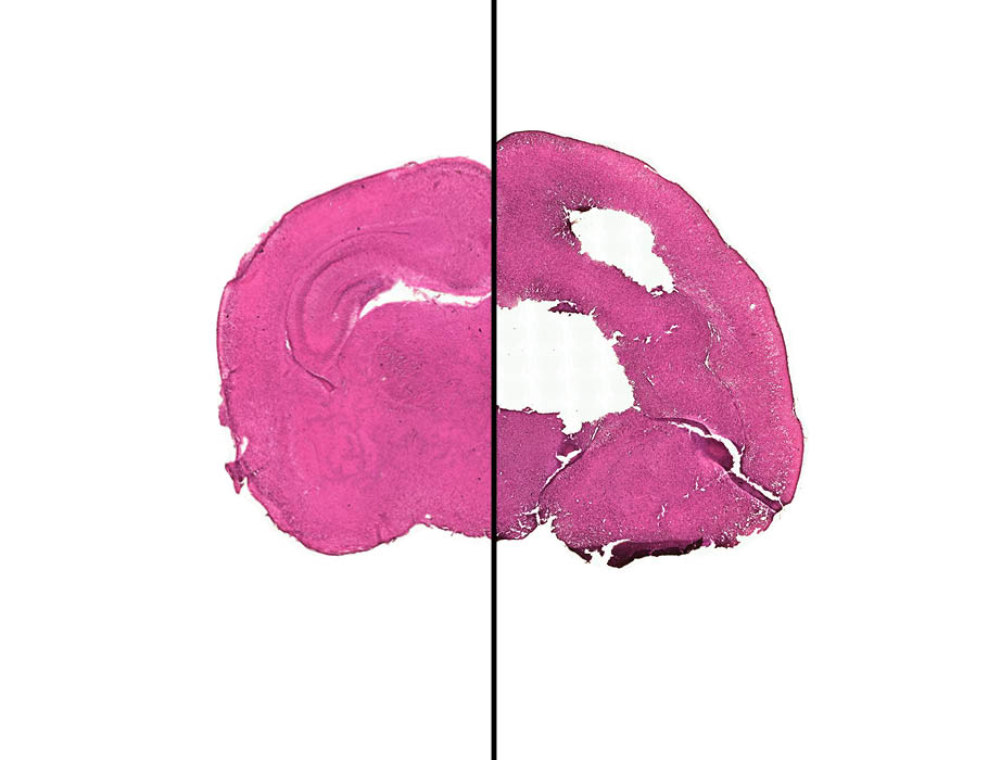 ScienceTM's tweet photo. A genetic study of nearly 2700 congenital cerebral ventriculomegaly (#CCV) hydrocephaly patients finds 25% of them have protein-damaging mutations, many of which are linked to neurodevelopmental disorders such as #ASD. @PiN_Harvard @KahleKristopher https://t.co/0O0YRtjKNy https://t.co/NopiaLggnW