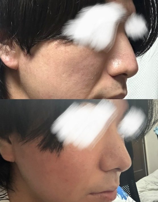aruuha_'s tweet photo. 術後6ヶ月が経ち、完成した姿にもすっかり見慣れました。
カウンセリングで希望していた「整形感のない、元からこの鼻だったような仕上がり」がそのまま実現できていて、とても満足しています。
#ノープロテー���鼻整形 #わし鼻矯正 #貴族施術 #渡韓整形 https://t.co/fKKthZJYCe