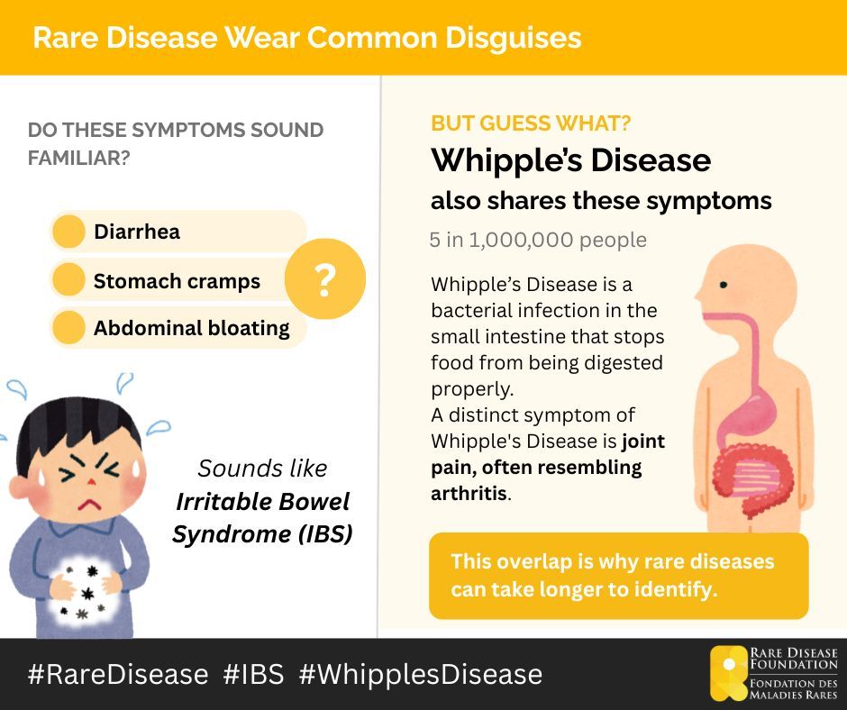 rarediseasefdn's tweet photo. Diarrhea. Stomach cramps. Abdominal bloating.

Sounds like IBS, but it could be Whipple's Disease, an ultra-rare bacterial infection affecting just 5 in 1,000,000 people.

The surprising tell? Joint pain that resembles arthritis. 🫀

#RareDisease #WhipplesDisease #IBS https://t.co/QTlDXvzX9x