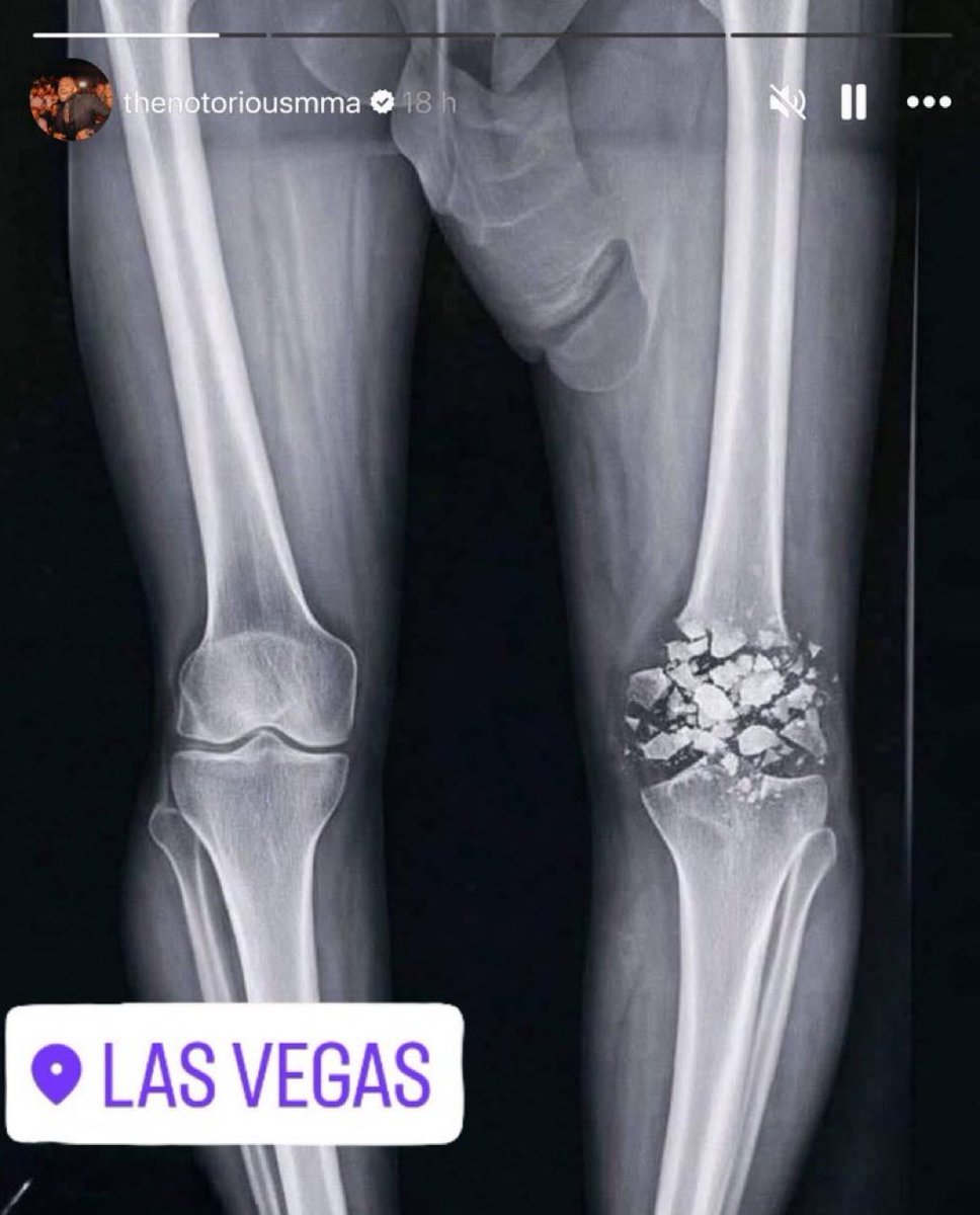 dancememecoin's tweet photo. 🚨 Conor McGregor releases X-ray and reveals a BRUTAL knee injury after his last fight against Max Holloway at #UFC329 

💥👊 Can he recover and dance again? https://t.co/EMh1s3NseW