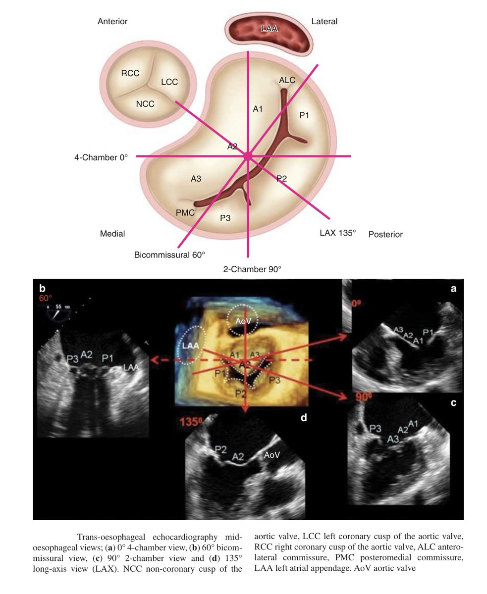 NephroP's tweet photo. Another #echoboards favorite
⭕️ Mitral valve segments and scallops seen on various #TEE (& TTE) views.
I’d mainly focus on -
✅ ME 4-chamber, commisural view and 3D short-axis (en face view)
✅ en face view tips:
⭕️12 o’clock: Aortic valve → adjacent to A2 (“Aortic = Anterior”).
⭕️9–10 o’clock: Left atrial appendage (LAA) → adjacent to the A1/P1 (anterolateral) commissure.
⭕️3–4 o’clock: Interatrial septum → adjacent to the A3/P3 (posteromedial) commissure.
Image courtesy: N. Moorjani et al., Operative Mitral and Tricuspid Valve Surgery (2018); Cardioserv.