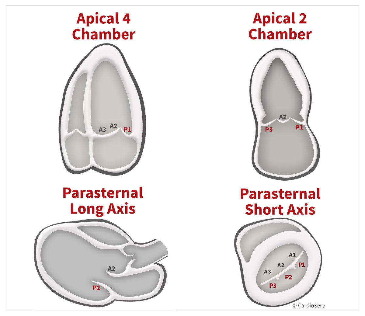 NephroP's tweet photo. Another #echoboards favorite
⭕️ Mitral valve segments and scallops seen on various #TEE (& TTE) views.
I’d mainly focus on -
✅ ME 4-chamber, commisural view and 3D short-axis (en face view)
✅ en face view tips:
⭕️12 o’clock: Aortic valve → adjacent to A2 (“Aortic = Anterior”).
⭕️9–10 o’clock: Left atrial appendage (LAA) → adjacent to the A1/P1 (anterolateral) commissure.
⭕️3–4 o’clock: Interatrial septum → adjacent to the A3/P3 (posteromedial) commissure.
Image courtesy: N. Moorjani et al., Operative Mitral and Tricuspid Valve Surgery (2018); Cardioserv.