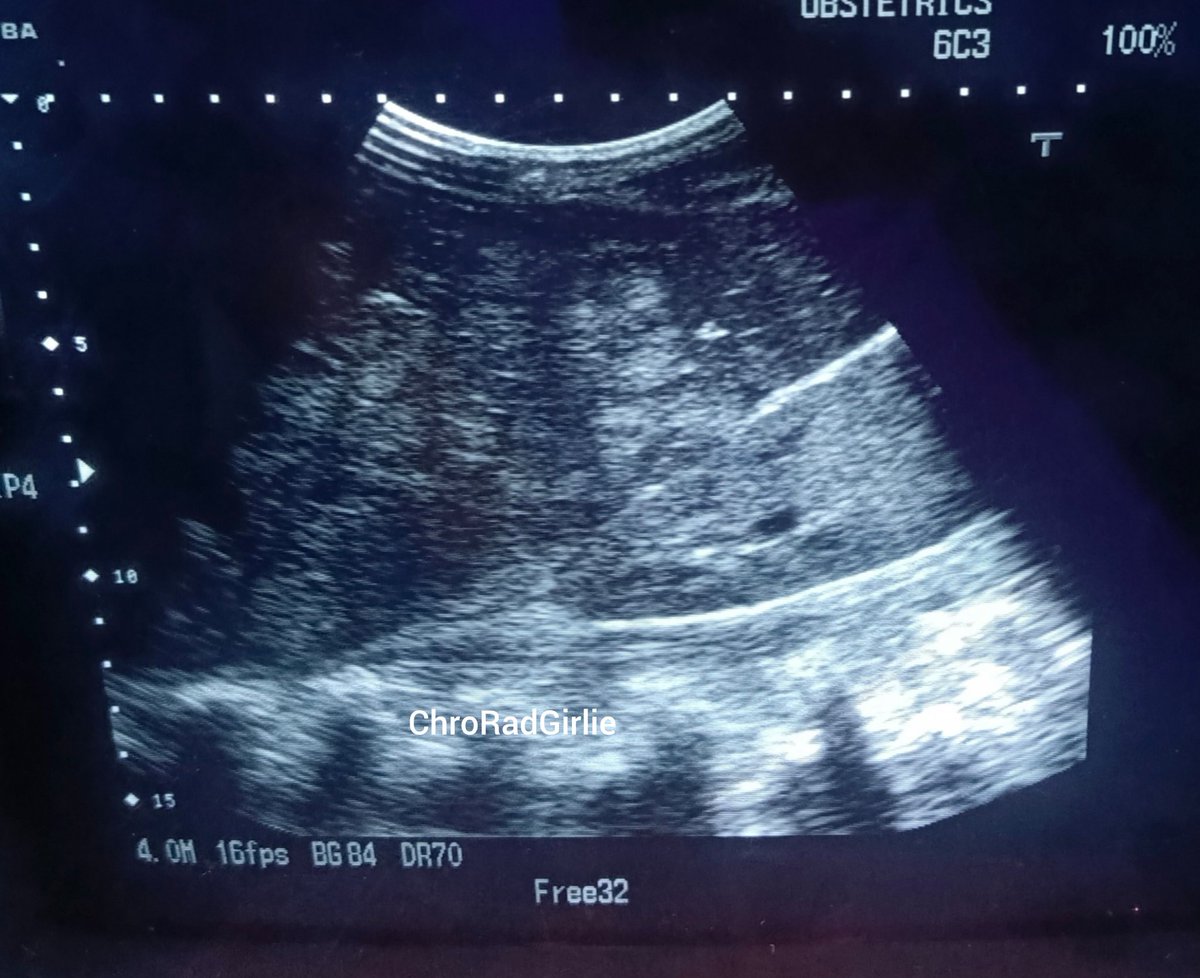 ChroRadGirlie's tweet photo. Severe abdominal pain. 

Patient said he has been on native treatment for so long and the pain kept getting worst. He decided to go the hospital. 

What's the diagnosis📍 https://t.co/K9zoCVKnNa