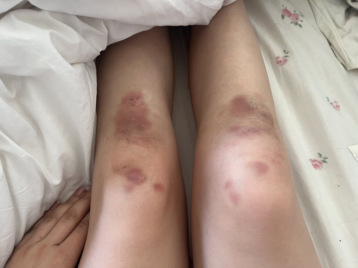kisscojess's tweet photo. ONE MONTH SINCE #KNEEGATE AND IM STILL IN SO MUCH PAIN AND STILL IN MY KNEE BRACE @Harry_Styles YOU WILL PAY https://t.co/t2JgPB7tXU