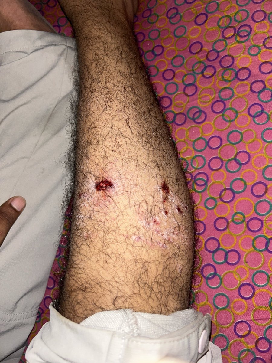 Prem_daksha's tweet photo. 🚨EMERGENCY पता राज बिल्डर गली 4, कर्ण विहार (वार्ड 15) खोड़ा में एक खूंखार कुत्ते का भारी आतंक है! यह अब तक 30+ लोगों पर जानलेवा हमला कर चुका है, कल रात मुझे भी काटा ,क्या प्रशासन किसी की मौत का इंतज़ार कर रहा है? तुरंत Dog Squad भेजें! @dm_ghaziabad @NMakanpur @112UttarPradesh https://t.co/fkYHZGnd4V
