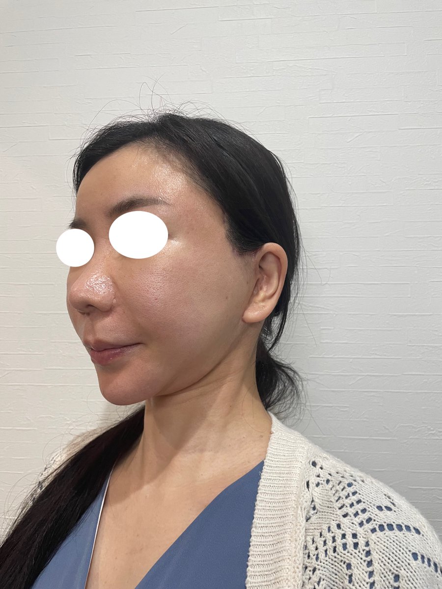 mmmpoopi's tweet photo. 術後約3ヶ月、経過。
頬の拘縮もかなり無くなりました。
術前と比べてかなりスッキリしています。
手術をして本当によかったです。 https://t.co/FG0Tou7KlN