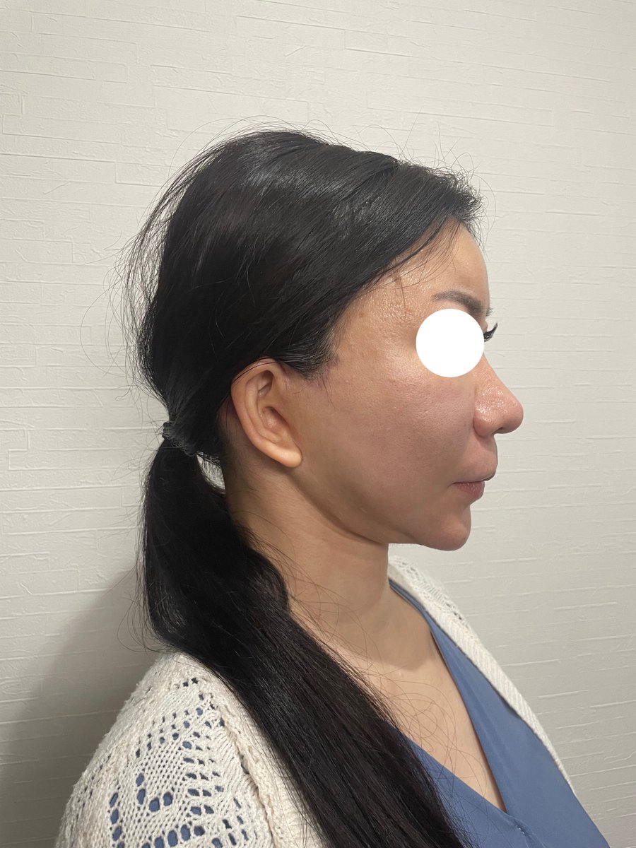 mmmpoopi's tweet photo. 術後約3ヶ月、経過。
頬の拘縮もかなり無くなりました。
術前と比べてかなりスッキリしています。
手術をして本当によかったです。 https://t.co/FG0Tou7KlN
