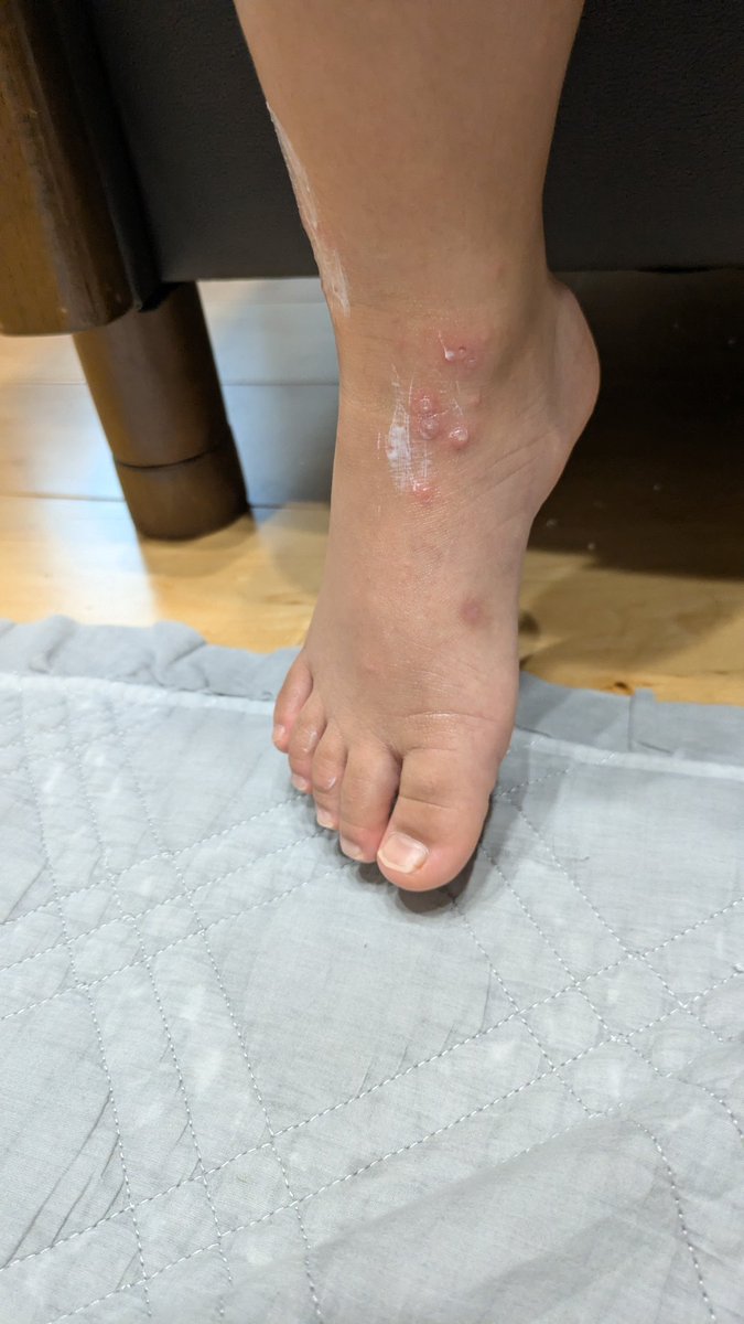 tonaahina's tweet photo. 次男手足口病🥲初めて見た、すごいね(T_T)発疹やばー
おしりや内ももにもあるー🥲
そして長男も発熱🥵
手足口病かな？学校はコロナが流行ってる😭どっちー😭⋯⋯
行くか、病院
#手足口病　#発疹　#高熱 https://t.co/gnHApUofHD