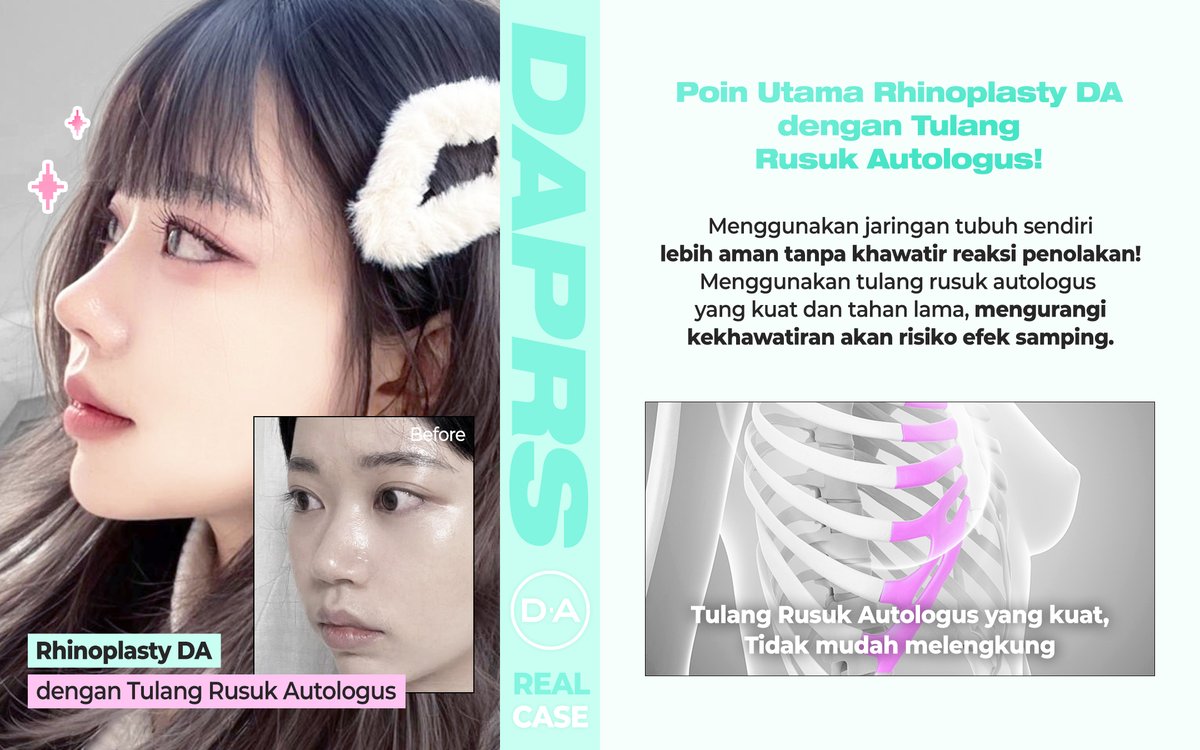 daprs_indo's tweet photo. ✨[Rhinoplasty DA]✨
Lihatlah perubahan yang signifikan model DA setelah melakukan operasi hidung di D.A!
Di D.A dijamin aman, hasilnya naturan dan cantik untuk enhance penampilan wajahmu! https://t.co/9jsasBv02M