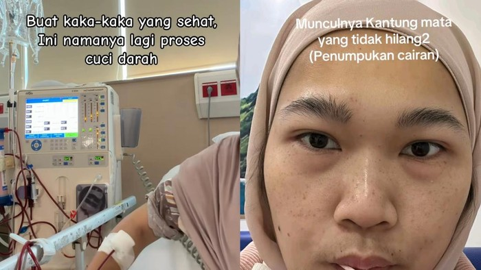 LambeSahamjja's tweet photo. Gejala yang dialami Sema sebelum divonis gagal ginjal stadium 5:
- banyak lebam di badan
- kantung mata yang tidak hilang-hilang (karena penumpukan cairan)
- tidak nafsu makan sama sekali
- penurunan berat badan
- pucat
- mual & muntah
- merasakan gejala serupa ada baiknya konsul