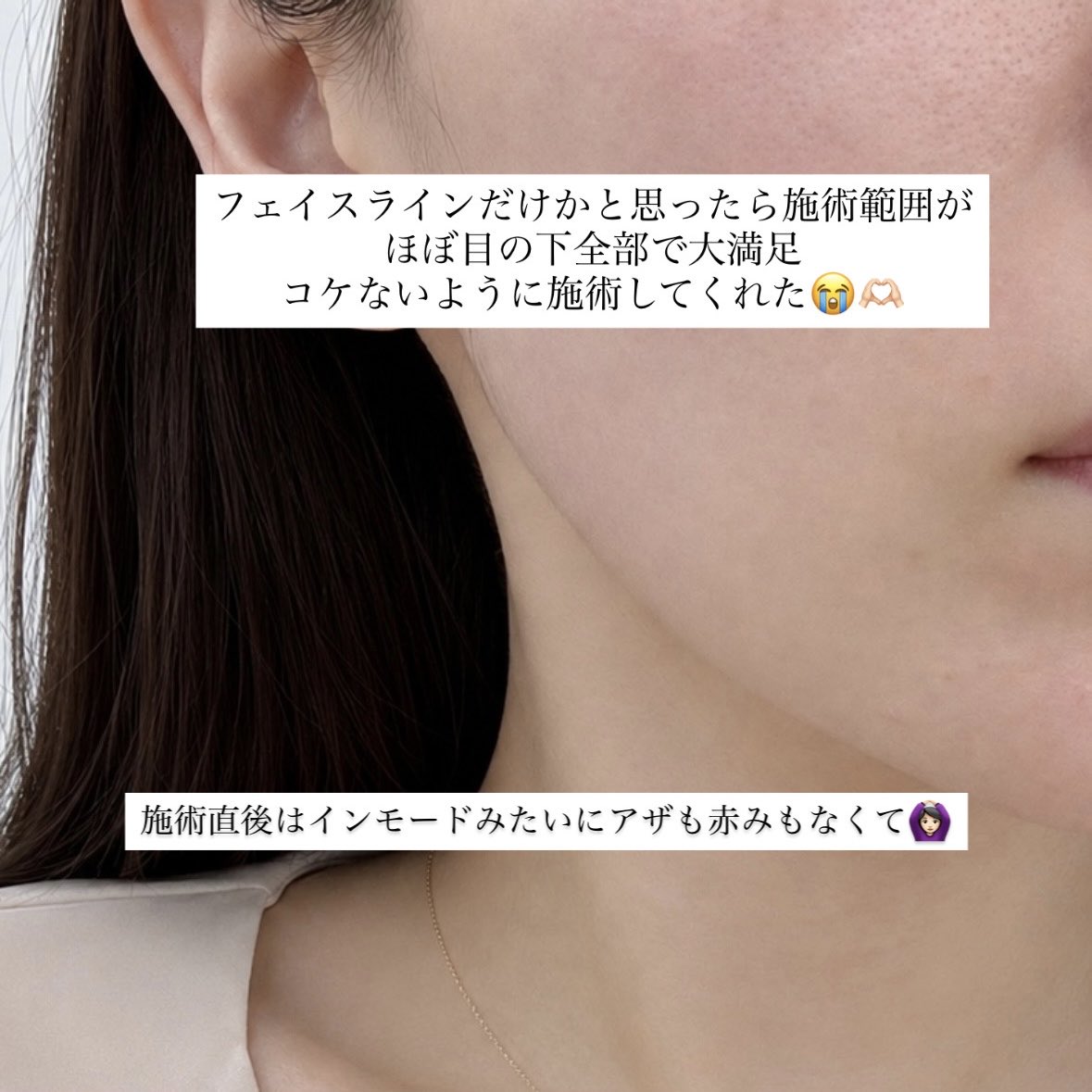 nnnpoonnn's tweet photo. 前回インモード受けたゴールデンバランス江南院で、今回はチタニウムリフト受けてきた

対応とカウンセリングが本当に良い！（せかされたくない+嫌な気持ちしたくないって日本人にはおすすめ）

施術も左右差見ながらコケないように施術してくれて満足🎶🎶

予約はLINEで簡単にできるし、1人の人も友達と来てる人も親子ぽい人もいた！
イベント料金だと安く受けれるからぜひクリニックのインスタとX見てみてね👊🏻❗️

【PR】
@goldenbalance_J

#ゴールデンバランスクリニック
#渡韓