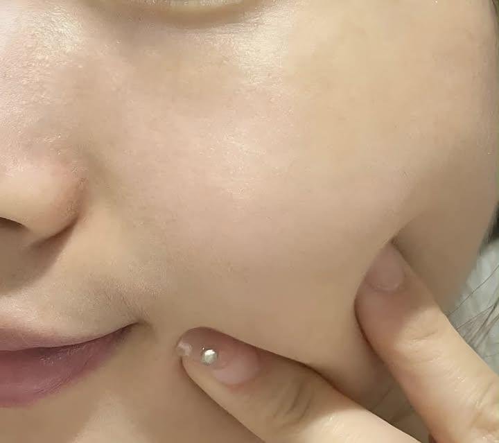 eyrarye's tweet photo. bye pipi polkadot....hello clean skin 🥹✨ https://t.co/au5miuMra0
