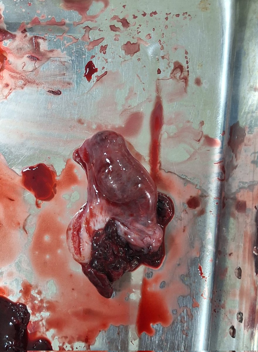 mpang636's tweet photo. Konten edukasi⚠️
Hasil konsepsi dari Kehamilan Ektopik Terganggu/Hamil diluar kandungan.
Gejala klinisnya hampir sama dengan penyakit usus buntu pada wanita yakni nyeri perut hebat pada bagian kanan bawah perut.
Dengan pemeriksaan USG dan Plano test untuk konfirmasi kasus KET. https://t.co/dXGoHSsdt4