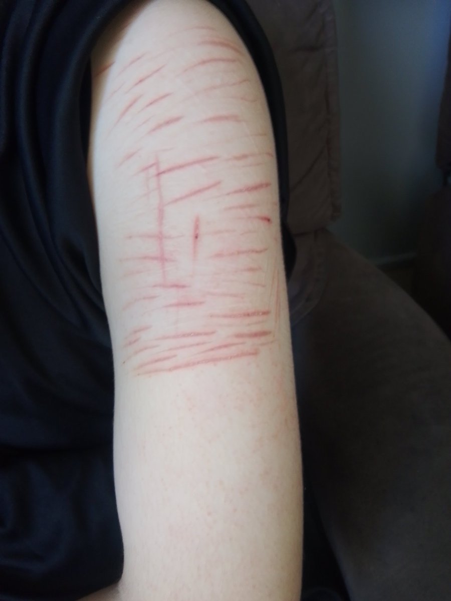 larryfacetwt's tweet photo. Upper arm/shoulders scars
 #scarspo #slittwt #shtwt #sledtwt 
FAKE/SFX MAKEUP/FAKE WOUNDS/ALL HEALED/HEALED PICS https://t.co/TaFuTztSgi