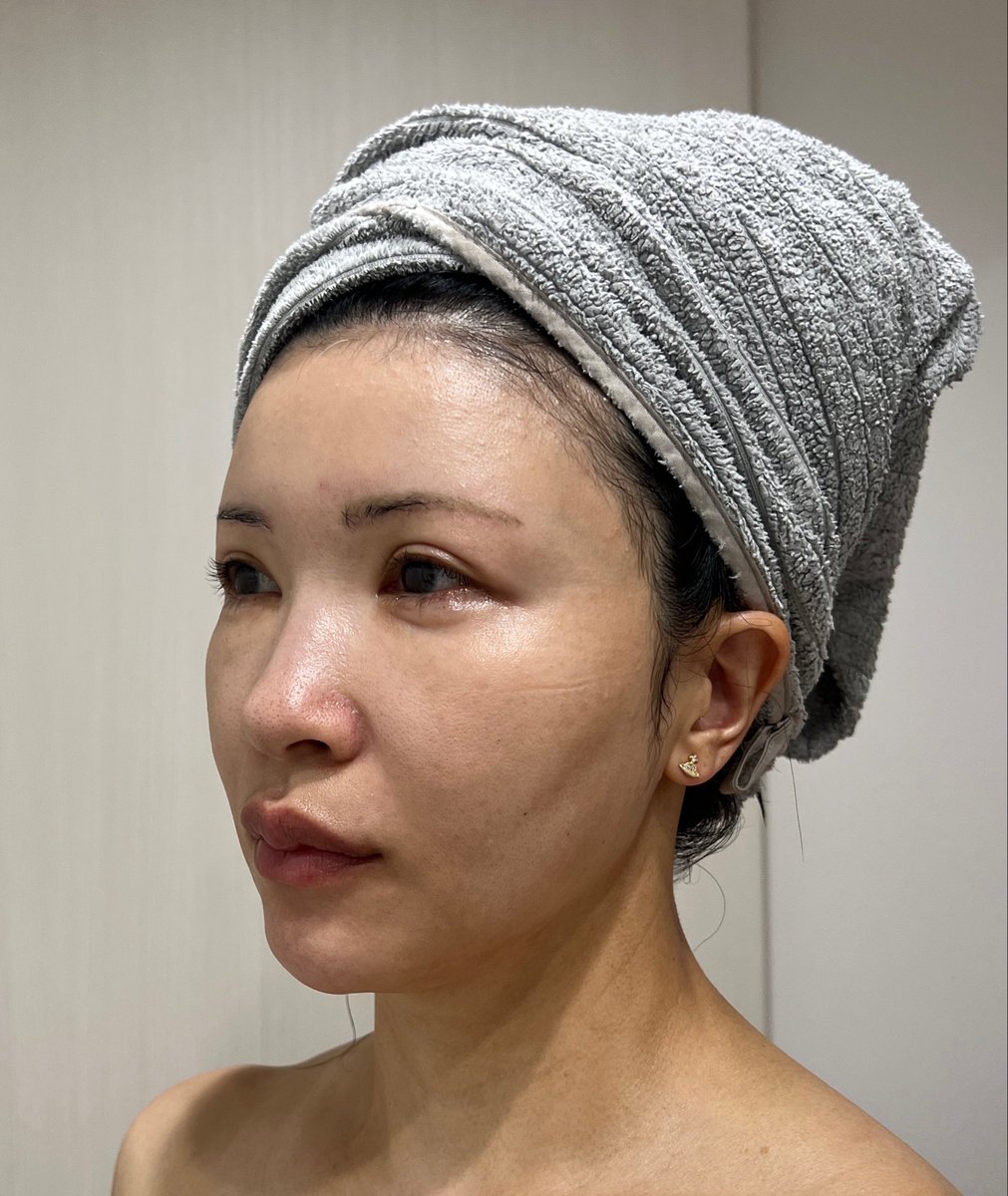 nonfilterbba's tweet photo. DT1ヶ月23日🤕もうすぐ2ヶ月‼︎
額・こめかみ・ほおこけ・ジョール・ほうれい線への脂肪注入＋バッカルファット除去＋ベイザー処理＋エンブレイズRF+糸リフト＋左側太腿脂肪吸引
右目下の腫れがなかなか良くならなくてもどかしい😫 https://t.co/At6GFmFKA8
