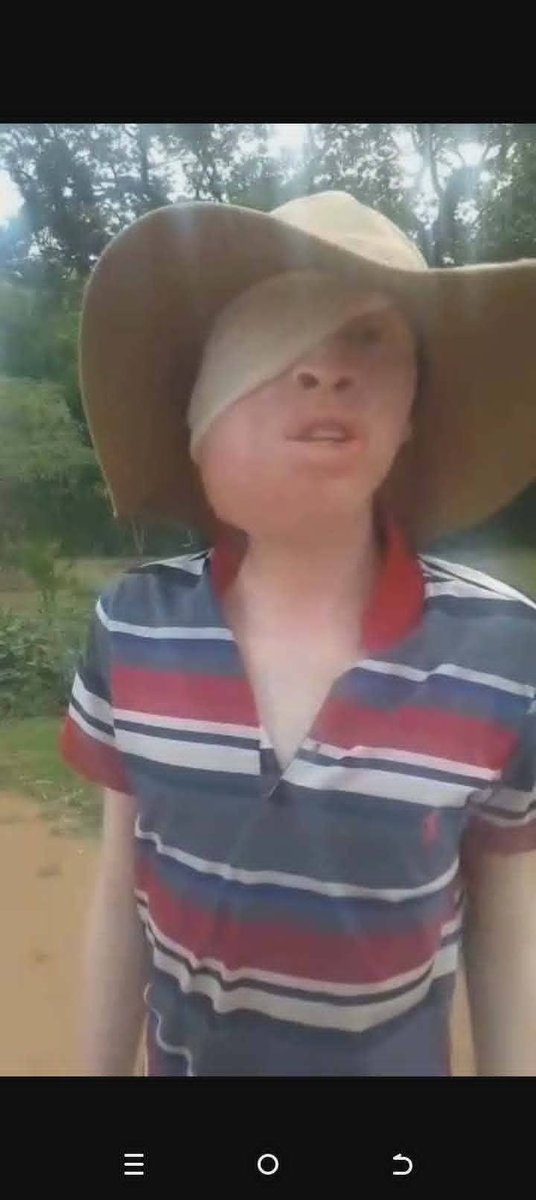 ruebutterfly's tweet photo. '1. HELP TANAKA HEAL

This is Tanaka. A young boy with albinism bracely fighting skin cancer. He recently had surgery to remove a tumor from his face and now has a reconstructive plate. Because of the surgery he cannot eat solid food. https://t.co/AfWPfpyR5o