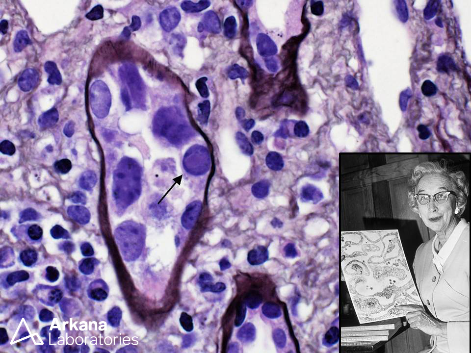 arkanalabs's tweet photo. The arrow points to an intranuclear viral inclusion characteristic of BK virus, one species of non-enveloped dsDNA viruses belonging to the polyoma virus family. Sarah Stewart (see inset), a physician and research scientist, studied viral oncogenesis (she was the first woman to earn an M.D. degree from Georgetown Medical School). Dr. Stewart and her collaborator, Dr. Bernice Eddy (Ph.D. virologist), renamed the parotid tumor virus originally discovered by Ludwik Gross “SE polyoma virus” (the “SE” was for “Stewart-Eddy”). Interestingly, Dr. Stewart like the name “omnioma” virus, but Eddy suggested the term “polyoma” virus since not all viral infections caused tumors in all tested animals. The detailed history of this virus family and its discoverers is chronicled in a fascinating article by Gregory J. Morgan (see below).

References
Morgan GJ. Ludwik Gross, Sarah Stewart, and the 1950s discoveries of Gross murine leukemia virus and polyoma virus. Stud Hist Philos Biol Biomed Sci. 2014 Dec;48 Pt B:200-9. PMID: 25223721.

Photograph of Dr. Sarah Stewart, 1971. Public domain (National Library of Medicine)

#TeachingPoints #kidneypath #renal #pathology
