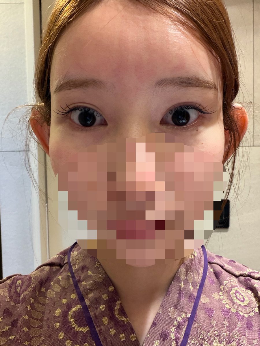 0123sweet's tweet photo. ここで経過ツリーにする( ^ᵕ^ )
⇽before
➝自然癒着とタレ目形成(皮膚切開)目尻切開の当日夜

直後は思ったより痛くてしんどかったけど、なんだかすでに綺麗になりそうな予感がする🫠🫠🫠❣️ https://t.co/0TGy7pIfwj