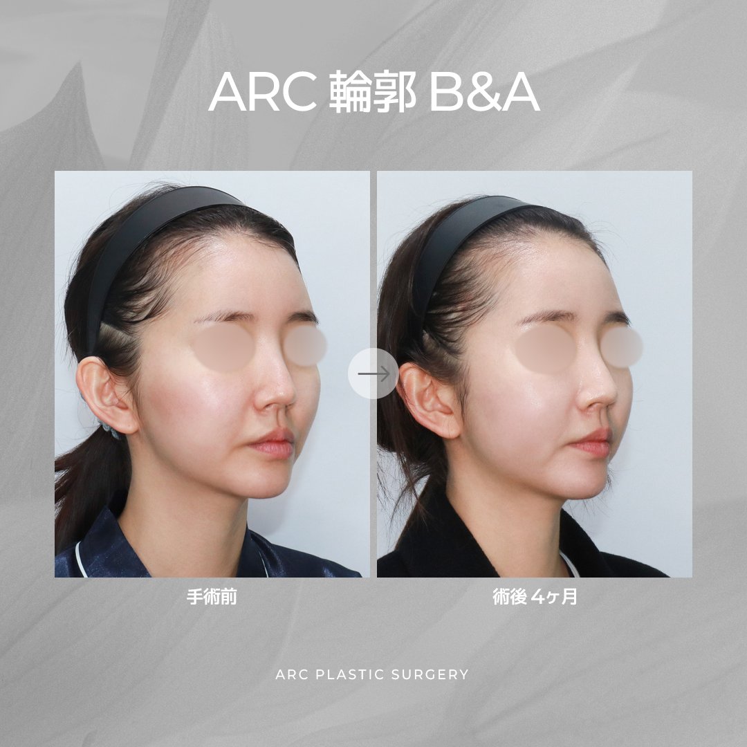 ARC_ps_'s tweet photo. ╭━━━━━━━━━━━━━━━━━━━━╮
🎊✨『ARC美容整形外科 5周年記念』✨🎊
╰━━━━━━━━━━━━━━━━━━━━╯

輪郭専門病院として、
5年間、技術だけを磨き続けてきました。

そして今――

皆様への感謝を込めて
ARCは『初心』に戻ります。🩵

通常価格『1,200万ウォン』の輪郭3点を…

━━━���━━━━━━━━━━
🔥🔥『899万ウォン』🔥🔥
━━━━━━━━━━━━━━

しかも今回は…

💎輪郭3点
💎皮質骨切除
💎咬筋縮小
💎バッカルファット除去

『全部まとめて』899万ウォン‼️😳✨

「ここまで入ってこの価格…!?」

そう思われる内容を、
5周年だからこそ実現しました🎁

━━━━━━━━━━━━━━
👨‍⚕️輪郭専門 クォン代表院長
━━━━━━━━━━━━━━

CTで骨格を立体分析🦴

✔️骨の厚み
✔️筋肉量
✔️脂肪量
✔️左右差

すべて診断した上で、
本当に必要な施術だけを組み合わせます✨

『削るだけ』では終わらない。
ARCだからできる輪郭デザインです💎

＼＼ 🎉EVENT詳細🎉 ／／

🌟今年中に手術を受けられる方
『20名様限定』

🌟『部分モニター条件』

🌟詳しくはLINEでお問い合わせ📩

━━━━━━━━━━━━━━
❤️参加方法❤️
━━━━━━━━━━━━━━

👍輪郭899ポストを『いいね』
🔄『リポスト』
📲スクリーンショットをLINEへ送るだけ✨

⚠️限定20名‼️
定員になり次第終了となります🙇‍♂️

『5周年だからできた価格。』
『5周年だからできた内容。』

輪郭専門ARCが、
もう一度"初心価格"で皆様をお迎えします💙🇰🇷
この機会をお見逃しなく💙LINE💌https://t.co/S0uJiuoIUh

#ARC美容整形外科 #5周年イベント #輪郭3点 #クォン代表院長 #輪郭専門 #韓国整形 #頬骨縮小 #エラ形成 #顎形成 #皮質骨切除 #咬筋縮小 #バッカルファット除去 🦴🏆💙🇰🇷✨