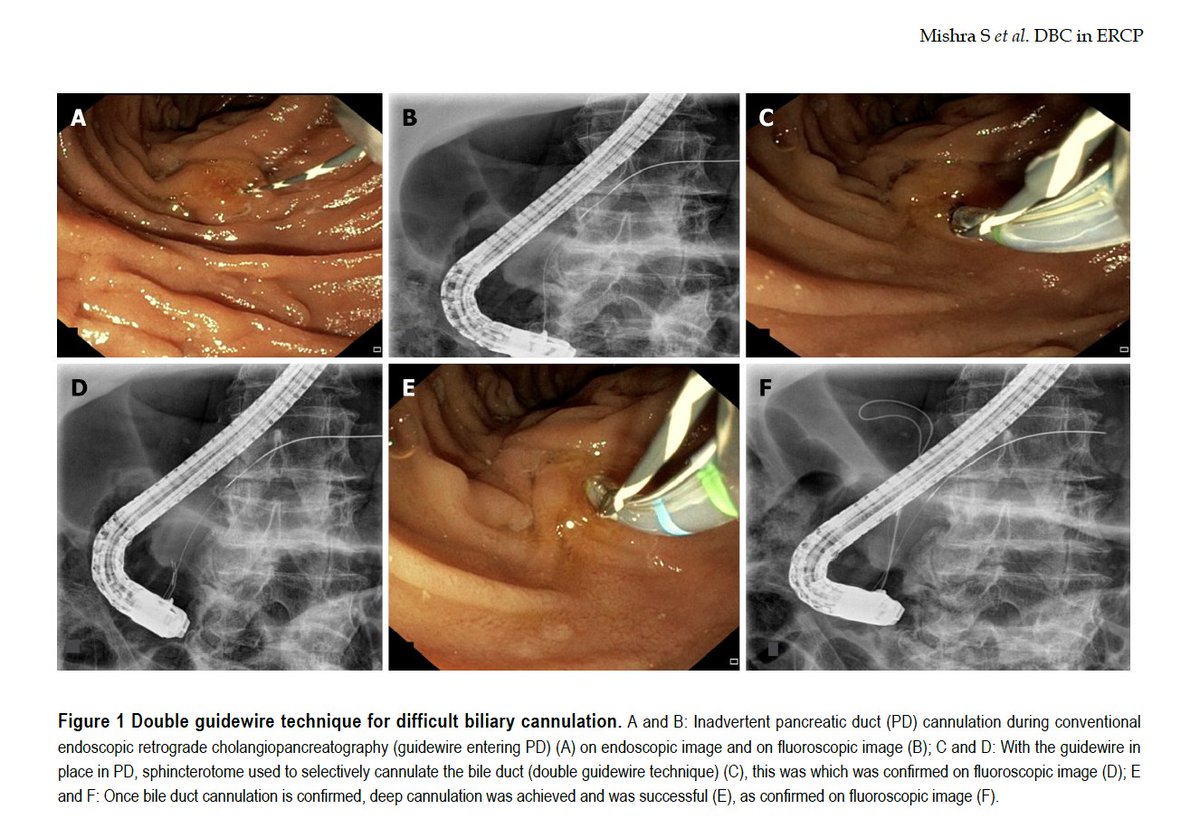 DharJahnvi's tweet photo. Excited to share our latest review article in World Journal of Gastroenterology (WJG) @Baishideng 😍

" Technical overview of difficult biliary cannulation in ERCP: A guide for the endoscopist "

Congratulations to my co-authors @ShubhraMishra91 @CrinoStefano and @Samanta_JayPGI !!! ❤️‍🔥

We have delved into:
✅ Free-hand techniques
✅ Over Pancreatic GW techniques 
✅ PD stent assisted techniques
✅ EUS RV
✅ PTBD RV and surgical RV techniques
✅ ERCP in altered anatomy 

🔥 Algorithm to handle a DBC during ERCP !!!

Have a nice read !!! 🧋☕️👇🔗
https://t.co/9T3X9L5m31

#GITwitter #ERCP #EUS #DBC #MEDtwitter #WJG
@GIscope_updates