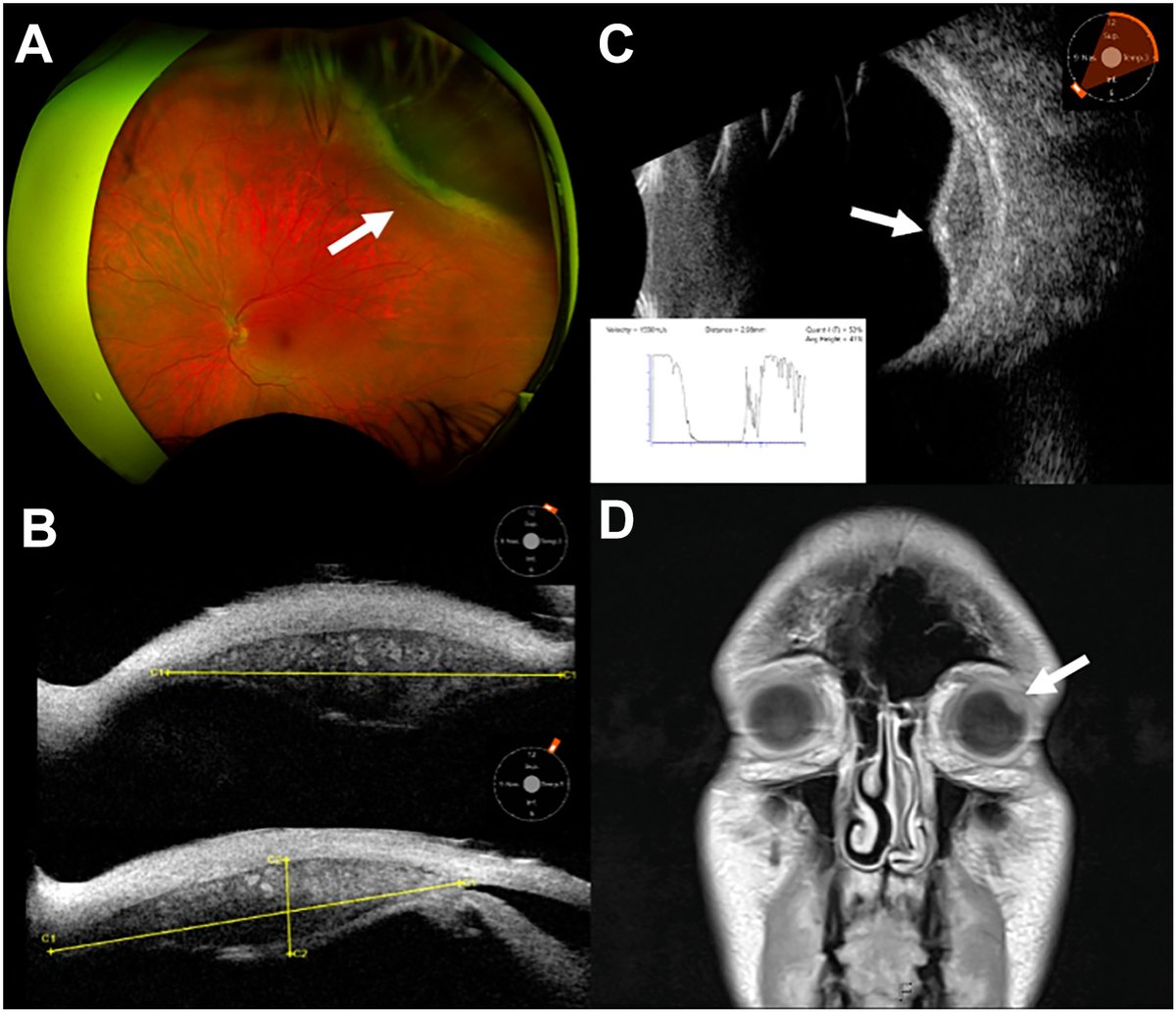 AAOjournal's tweet photo. A 51-year-old man underwent brain magnetic resonance imaging that disclosed a left globe mass. Fundus imaging showed an amelanotic lesion with posterior exudative deposits, without orange pigment or subretinal fluid (A). Ultrasound biomicroscopy (B) and B-scan (C) revealed a solid ciliary body mass with marked intralesional vascularity, hyperechoic calcific deposits, and A-scan (C, subset) demonstrated low internal reflectivity. Magnetic resonance imaging showed a T1 hyperintense ciliary body mass, but was unchanged compared with magnetic resonance imaging from 10 years prior (D, 3.4 mm height). The constellation of a ciliary body mass, intrinsic vascularity, low reflectivity, increased transillumination, calcific deposits, and decade-long stability favored leiomyoma. Although definitive diagnosis would require histopathologic examination with surgical biopsy, the lesion’s indolent course supported continued surveillance.
https://t.co/CcEjynviZn
#ophthalmology #retina