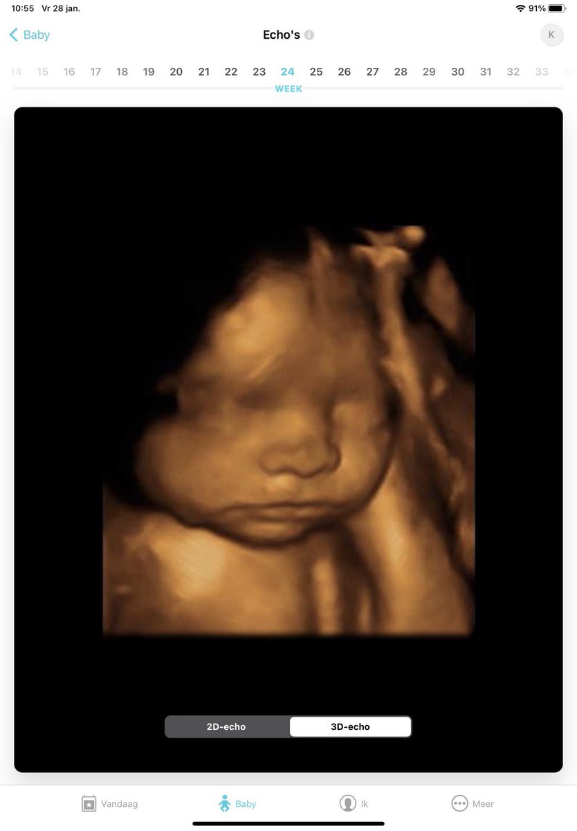 KarinSnippe2's tweet photo. Daar wordt wel érg makkelijk over gesproken, rechten van de moeder en zo. 
Dit 👇🏻 is een baby van 24 weken. Wie heeft het over zijn/haar rechten? 
#NieuwsVanDeDag https://t.co/2nTebpNdz9