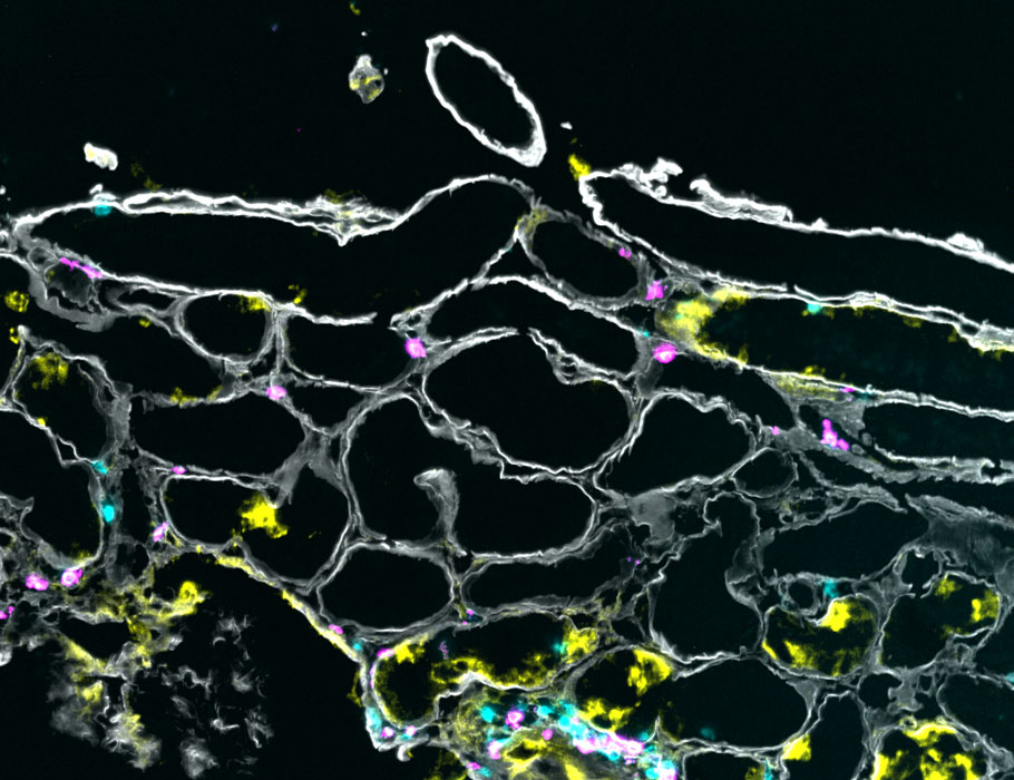 ScienceTM's tweet photo. A study of T cells from patients with #lupus #nephritis shows these cells are activated by local cytokines and could mediate injury in inflamed kidneys, with some T cells reactive to potentially latent #EpsteinBarr and #CMV. @ChariteBerlin @P_Enghard https://t.co/ZsBonNd4eC https://t.co/Wse8o0NngM