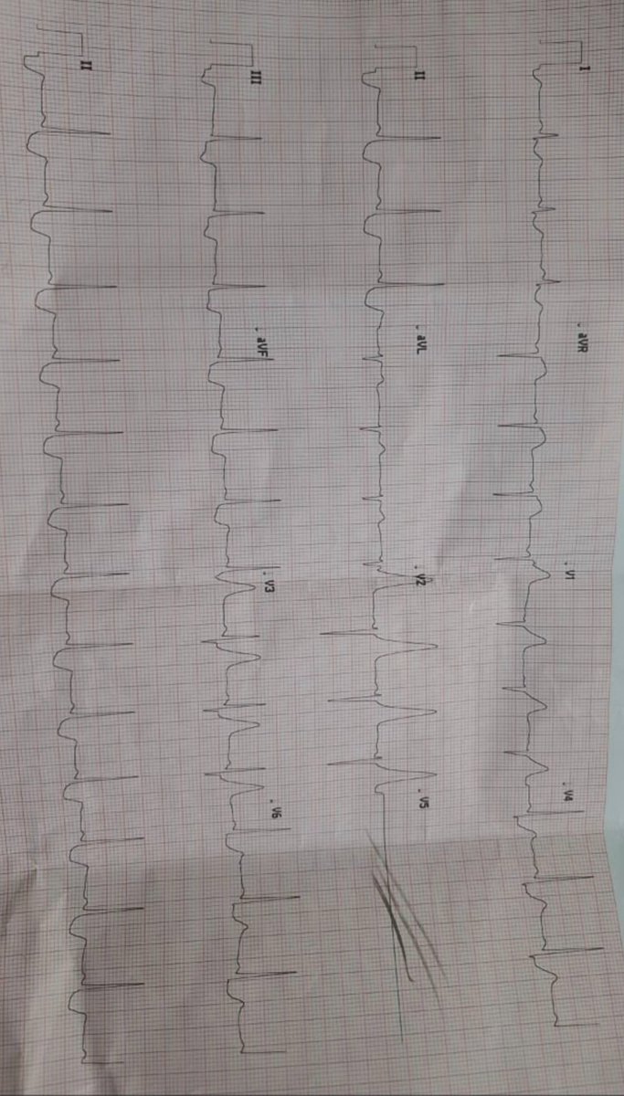 pahadi__doc's tweet photo. 40 years old male with complaints of left side non Radiating g chest pain since 5 hours, non - radiating. 
a/w sweating and shortness of breath.
#MedX https://t.co/ynrUfORwhm
