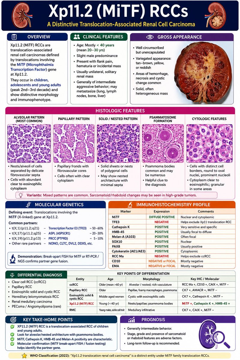 RobinYadav2009's tweet photo. MiTF RCCs. Positive for Cathepsin K, HMB45, Melan A. #pathtwitter #medtwitter #renalcellcancer https://t.co/ZTcHxSUALO