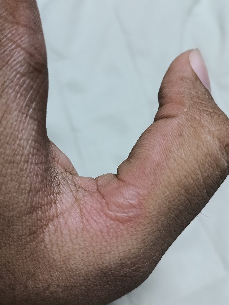 pattypeter14411's tweet photo. I was cleaning up my garden and the yard today and after I showered I was this on my hand, does anyone know what what is? I hope it's not an infection https://t.co/SkOfitCVHP