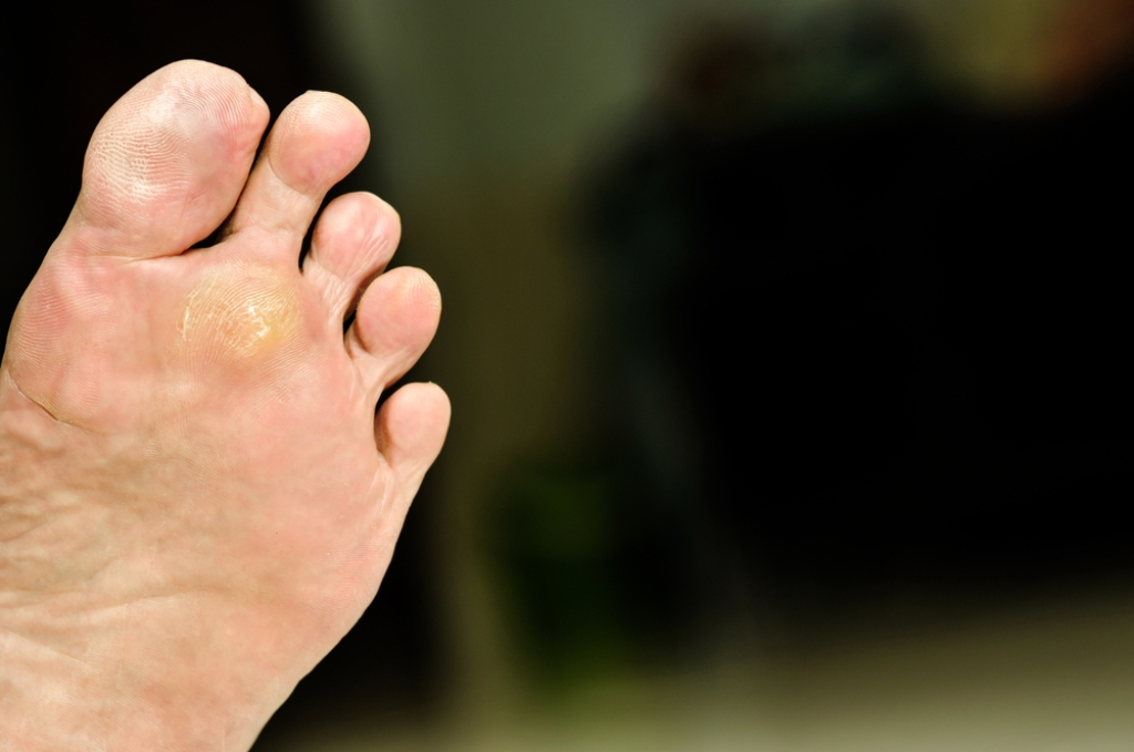 LouisMacDonald6's tweet photo. Plantar Wart Symptoms and Effective Treatment https://t.co/fBa775HapZ https://t.co/ECbcvL6ZMG
