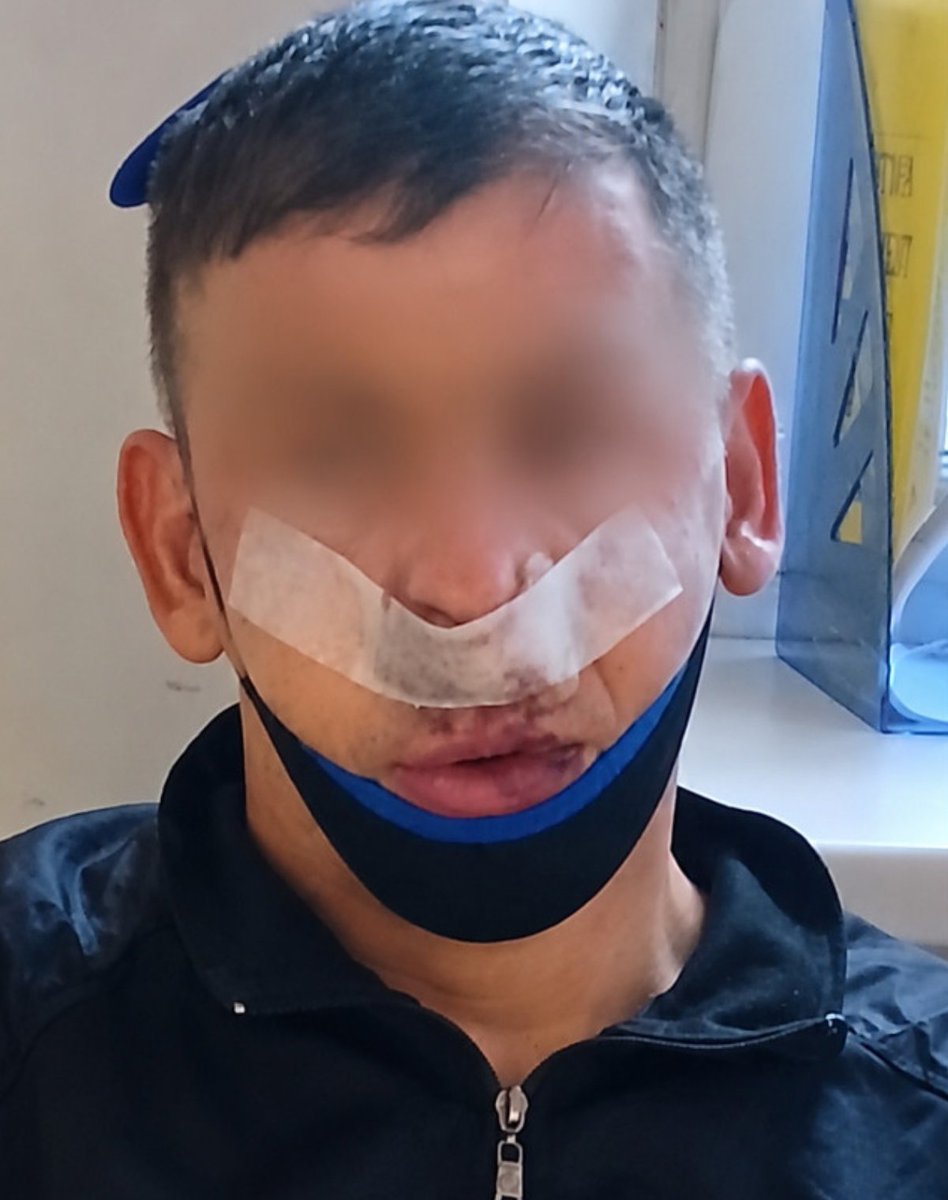 ZespolBrauna's tweet photo. Taki wygląda Łodzianin pobity przez braunderowca.

Do zdarzenia doszło wczoraj w Łodzi, gdy Łodzianin wyszedł z kamienicy. Został zaczepiony i usłyszał, że jako Ukrainiec ma wypierdalać z Polski.

Gdy Łodzianin zaczął tłumaczyć, że jest Polakiem został dwa razy uderzony w twarz. https://t.co/kRWPX9rNdh