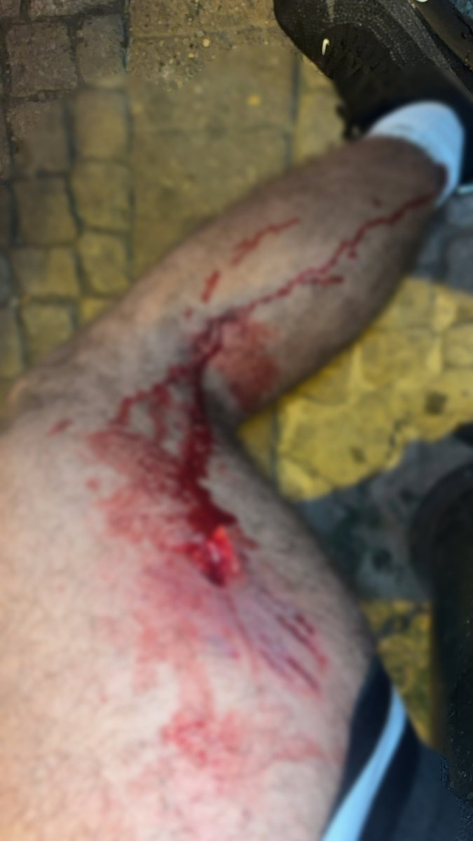 HemRazi111lll1l's tweet photo. Hassas İçerik 🚨🚨🚨

Geçtiğimiz pazar günü, Almanya'dan memlekete  gelen vatandaş  Ortaköyde yürüyüş yaparken Çırağan Sarayı yolu üzerinde başıboş it saldırısına uğramış. 
Durumu bu.

Merhamet hikayesi dinleye dinleye geldiğimiz durumda hiç bir değişiklik yok. 
Mayıs sonunda suç duyurusunda bulunacaktınız  başıboş itleri toplamayan belediyelere ne oldu o iş. 

@gul_davut @TC_istanbul